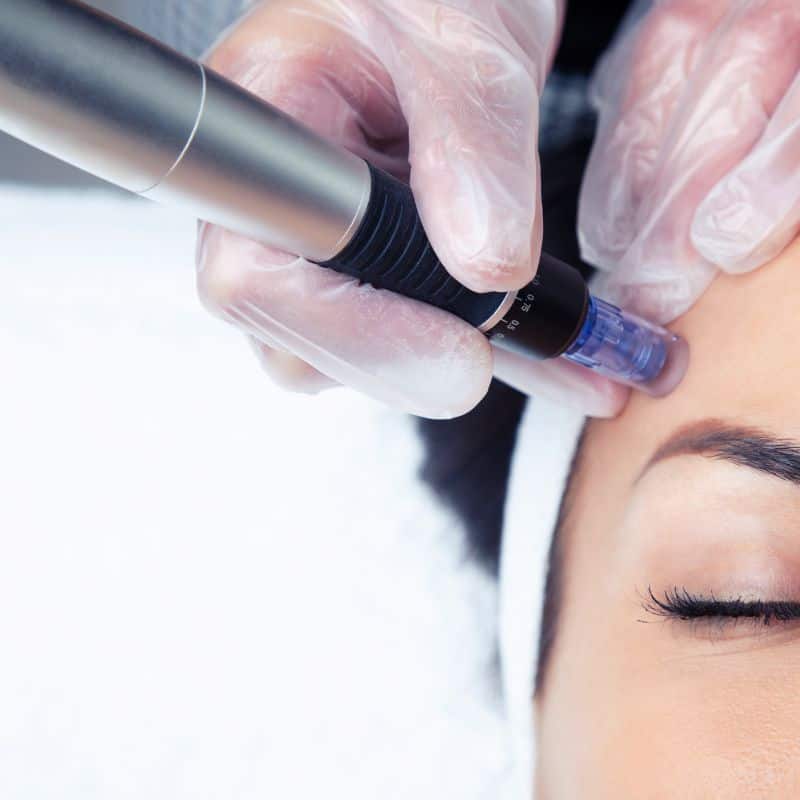 Morpheus8 treatment Benson from Lipo Sculpt - Book in today!